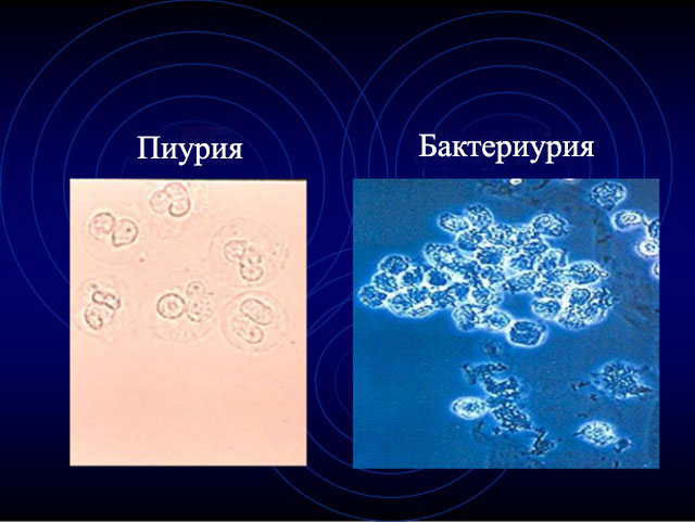 Пиурия бактериурия клетки под микроскопом