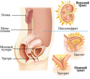 Болезни женской мочевыделительной системы