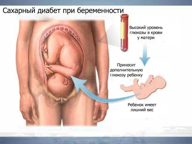 Глюкоза беременная схема